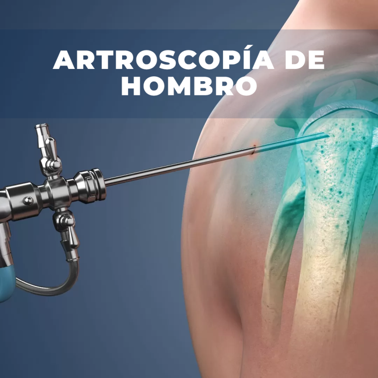 Artroscopia hombro