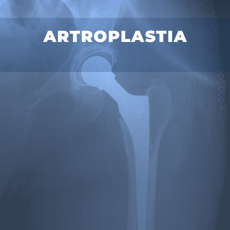 artroplastia